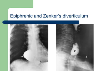 University of
Alexandria
Epiphrenic and Zenker’s diverticulum
 