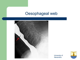 University of
Alexandria
Oesophageal web
 