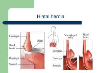 University of
Alexandria
Hiatal hernia
 