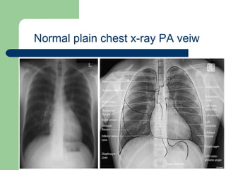 University of
Alexandria
Normal plain chest x-ray PA veiw
 