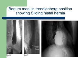 University of
Alexandria
Barium meal in trendlenberg position
showing Sliding hiatal hernia
 