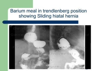 University of
Alexandria
Barium meal in trendlenberg position
showing Sliding hiatal hernia
 