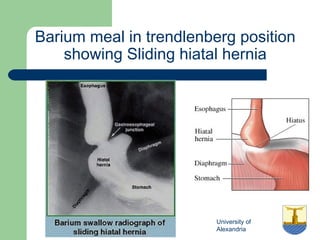 University of
Alexandria
Barium meal in trendlenberg position
showing Sliding hiatal hernia
 
