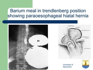 University of
Alexandria
Barium meal in trendlenberg position
showing paraoesophageal hiatal hernia
 