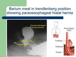 University of
Alexandria
Barium meal in trendlenberg position
showing paraoesophageal hiatal hernia
 