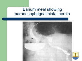 University of
Alexandria
Barium meal showing
paraoesophageal hiatal hernia
 