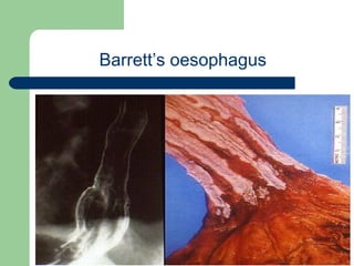 University of
Alexandria
Barrett’s oesophagus
 