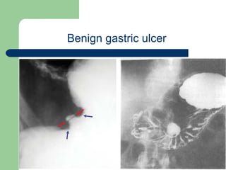 University of
Alexandria
Benign gastric ulcer
 