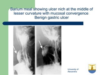 University of
Alexandria
Barium meal showing ulcer nich at the middle of
lesser curvature with mucosal convergence
Benign gastric ulcer
 
