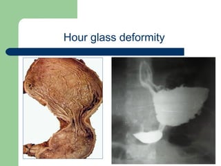 University of
Alexandria
Hour glass deformity
 