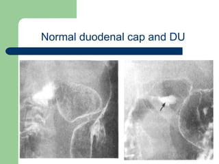University of
Alexandria
Normal duodenal cap and DU
 