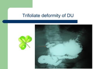 University of
Alexandria
Trifoliate deformity of DU
 