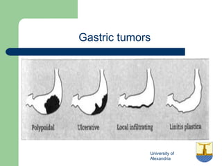 University of
Alexandria
Gastric tumors
 