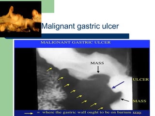 University of
Alexandria
Malignant gastric ulcer
 