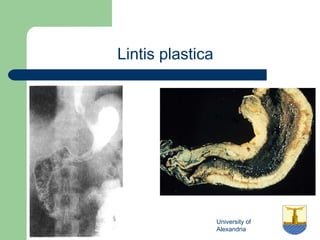 University of
Alexandria
Lintis plastica
 