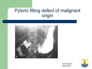 University of
Alexandria
Pyloric filling defect of malignant
origin
 
