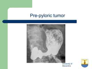 University of
Alexandria
Pre-pyloric tumor
 