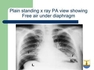 University of
Alexandria
Plain standing x ray PA view showing
Free air under diaphragm
 