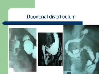 University of
Alexandria
Duodenal diverticulum
 