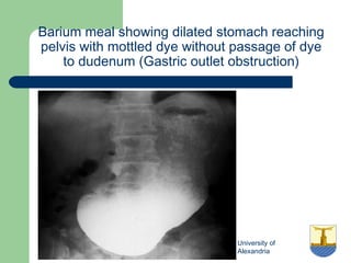 University of
Alexandria
Barium meal showing dilated stomach reaching
pelvis with mottled dye without passage of dye
to dudenum (Gastric outlet obstruction)
 
