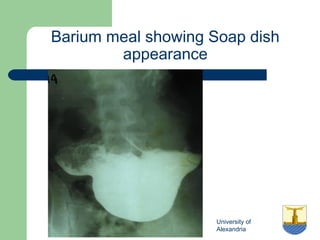 University of
Alexandria
Barium meal showing Soap dish
appearance
 