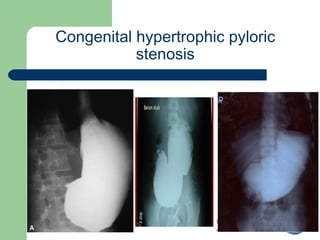 University of
Alexandria
Congenital hypertrophic pyloric
stenosis
 