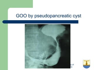University of
Alexandria
GOO by pseudopancreatic cyst
 