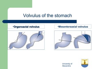University of
Alexandria
Volvulus of the stomach
•Organoaxial volvulusOrganoaxial volvulus •Mesenteroaxial volvulus
 