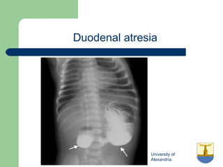 University of
Alexandria
Duodenal atresia
 