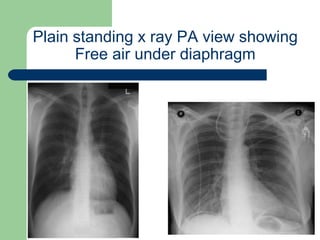 University of
Alexandria
Plain standing x ray PA view showing
Free air under diaphragm
 