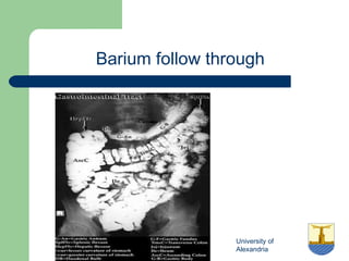 University of
Alexandria
Barium follow through
 
