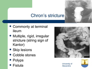 University of
Alexandria
Chron’s stricture
 Commonly at terminal
ileum
 Multiple, rigid, irregular
stricture (string sign of
Kantor)
 Skip lesions
 Cobble stones
 Polyps
 Fistula
 