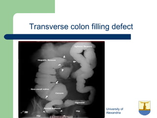 University of
Alexandria
Transverse colon filling defect
 