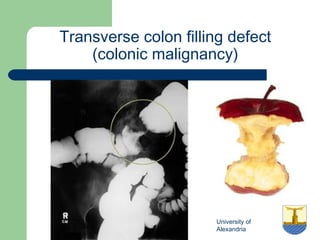 University of
Alexandria
Transverse colon filling defect
(colonic malignancy)
 