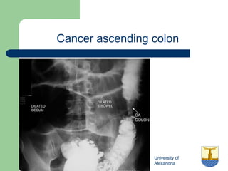 University of
Alexandria
Cancer ascending colon
 