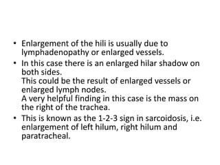 • Enlargement of the hili is usually due to
lymphadenopathy or enlarged vessels.
• In this case there is an enlarged hilar shadow on
both sides.
This could be the result of enlarged vessels or
enlarged lymph nodes.
A very helpful finding in this case is the mass on
the right of the trachea.
• This is known as the 1-2-3 sign in sarcoidosis, i.e.
enlargement of left hilum, right hilum and
paratracheal.
 