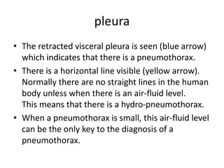 pleura
• The retracted visceral pleura is seen (blue arrow)
which indicates that there is a pneumothorax.
• There is a horizontal line visible (yellow arrow).
Normally there are no straight lines in the human
body unless when there is an air-fluid level.
This means that there is a hydro-pneumothorax.
• When a pneumothorax is small, this air-fluid level
can be the only key to the diagnosis of a
pneumothorax.
 