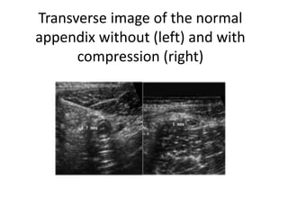 Transverse image of the normal
appendix without (left) and with
compression (right)
 