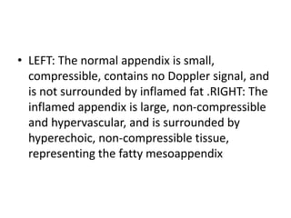 • LEFT: The normal appendix is small,
compressible, contains no Doppler signal, and
is not surrounded by inflamed fat .RIGHT: The
inflamed appendix is large, non-compressible
and hypervascular, and is surrounded by
hyperechoic, non-compressible tissue,
representing the fatty mesoappendix
 