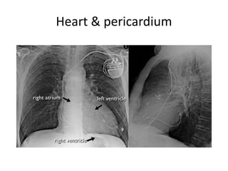 Heart & pericardium
 
