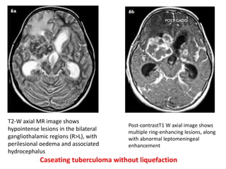 T2-W axial MR image shows
hypointense lesions in the bilateral
gangliothalamic regions (R>L), with
perilesional oedema and associated
hydrocephalus
Post-contrastT1 W axial image shows
multiple ring-enhancing lesions, along
with abnormal leptomeningeal
enhancement
Caseating tuberculoma without liquefaction
 