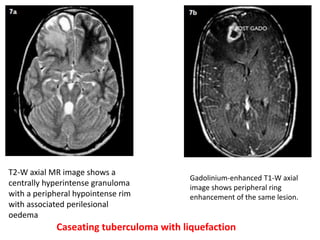 T2-W axial MR image shows a
centrally hyperintense granuloma
with a peripheral hypointense rim
with associated perilesional
oedema
Gadolinium-enhanced T1-W axial
image shows peripheral ring
enhancement of the same lesion.
Caseating tuberculoma with liquefaction
 