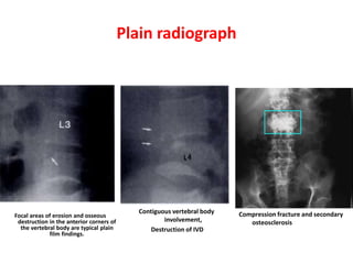 Focal areas of erosion and osseous
destruction in the anterior corners of
the vertebral body are typical plain
film findings.
Contiguous vertebral body
involvement,
Destruction of IVD
Compression fracture and secondary
osteosclerosis
Plain radiograph
 