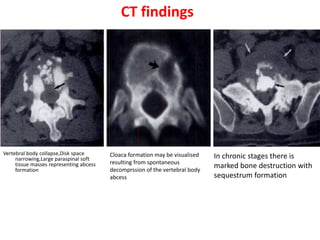 CT findings
Vertebral body collapse,Disk space
narrowing,Large paraspinal soft
tissue masses representing abcess
formation
Cloaca formation may be visualised
resulting from spontaneous
decomprssion of the vertebral body
abcess
In chronic stages there is
marked bone destruction with
sequestrum formation
 