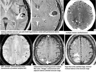 multiple nodular calcified lesions
Hypo foci in the calcified stage, minimal
residual edema in the Granular stage
GRE - multiple "blooming black dots“
characteristic of nodular calcified NCC.
enhancement of healing granular nodular
NCC cysts, "Shaggy” enhancement with
adjacent edema-colloidal vesicular stage.
Solitary colloidal vesicular cyst with FLAIR hyperintense scolex with perilesional edema
and "shaggy” enhancement
 