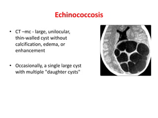 Echinococcosis
• CT –mc - large, unilocular,
thin-walled cyst without
calcification, edema, or
enhancement
• Occasionally, a single large cyst
with multiple "daughter cysts"
 