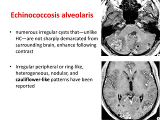 • numerous irregular cysts that—unlike
HC—are not sharply demarcated from
surrounding brain, enhance following
contrast
• Irregular peripheral or ring-like,
heterogeneous, nodular, and
cauliflower-like patterns have been
reported
Echinococcosis alveolaris
 