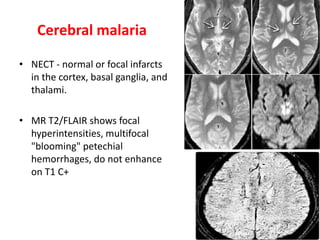 Cerebral malaria
• NECT - normal or focal infarcts
in the cortex, basal ganglia, and
thalami.
• MR T2/FLAIR shows focal
hyperintensities, multifocal
"blooming" petechial
hemorrhages, do not enhance
on T1 C+
 