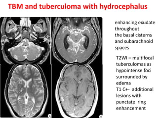 TBM and tuberculoma with hydrocephalus
enhancing exudate
throughout
the basal cisterns
and subarachnoid
spaces
T2WI – multifocal
tuberculomas as
hypointense foci
surrounded by
edema
T1 C+- additional
lesions with
punctate ring
enhancement
 