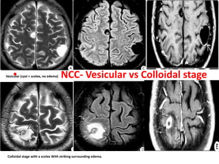 • NCC- Vesicular vs Colloidal stageVesicular (cyst + scolex, no edema)
Colloidal stage with a scolex With striking surrounding edema.
 